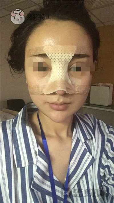 上海华美李庭勋隆鼻案例价格分享,这张混血脸你招架得住吗?