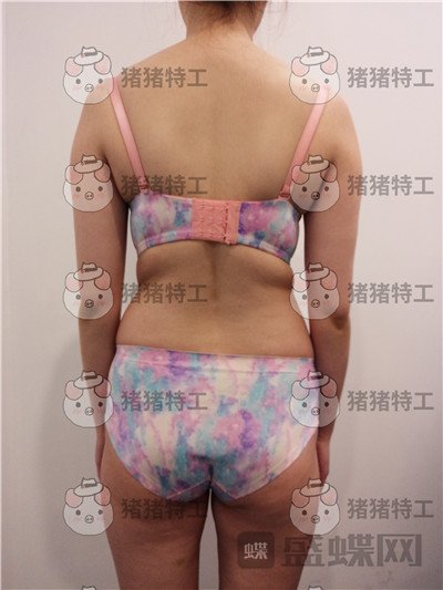 重庆瑞俪胡小义吸脂案例价格分享,这样的美腿终于可以穿上超短裙了!