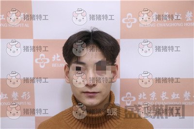 北京长虹于志宏鼻部手术案例价格分享,追求完美的男神现在如愿以偿。