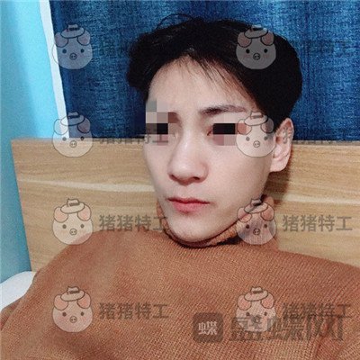北京长虹于志宏鼻部手术案例价格分享,追求完美的男神现在如愿以偿。