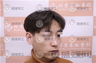 北京长虹于志宏鼻部手术案例价格分享,追求完美的男神现在如愿以偿。