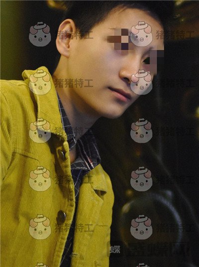 北京长虹于志宏鼻部手术案例价格分享,追求完美的男神现在如愿以偿。