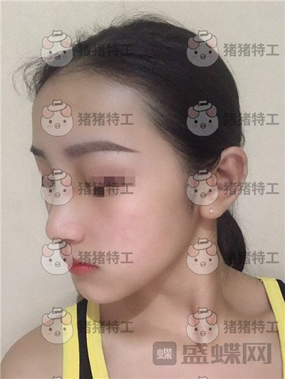 长沙南湖何怀万隆鼻案例价格分享，做个鼻子竟然五官都精致了很多！
