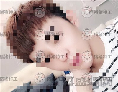 上海华美叶丽萍垫下巴案例价格分享,谁说只有女孩子尖尖下巴好看?