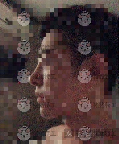 上海华美叶丽萍垫下巴案例价格分享,谁说只有女孩子尖尖下巴好看?