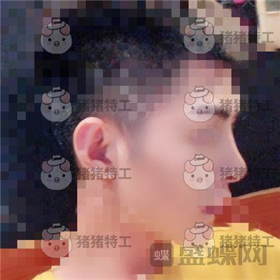上海华美叶丽萍垫下巴案例价格分享,谁说只有女孩子尖尖下巴好看?