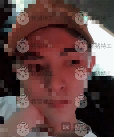 上海华美叶丽萍垫下巴案例价格分享,谁说只有女孩子尖尖下巴好看?