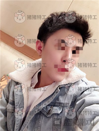 上海华美叶丽萍垫下巴案例价格分享,谁说只有女孩子尖尖下巴好看?