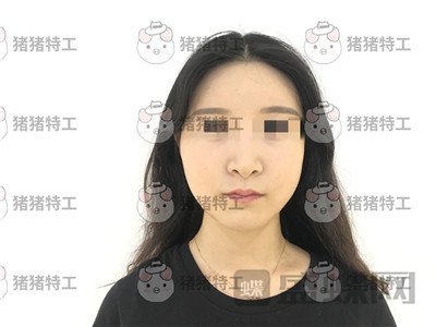 上海华美李志海下颌角整形案例价格分享,眼瞅着这张脸小了整整两圈。。