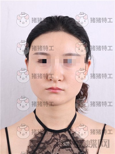 上海华美李志海下颌角整形案例价格分享,眼瞅着这张脸小了整整两圈。。