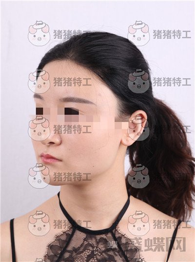 上海华美李志海下颌角整形案例价格分享,眼瞅着这张脸小了整整两圈。。
