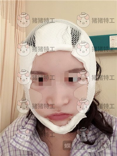 上海华美李志海下颌角整形案例价格分享,眼瞅着这张脸小了整整两圈。。