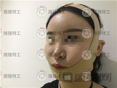 上海华美李志海下颌角整形案例价格分享,眼瞅着这张脸小了整整两圈。。