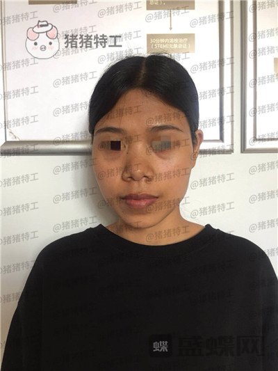 上海愉悦美联臣陈红梅脂肪填充案例价格分享,大家来帮我看看这是整形失败了吗?