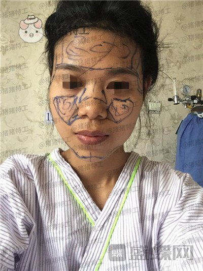 上海愉悦美联臣陈红梅脂肪填充案例价格分享,大家来帮我看看这是整形失败了吗?