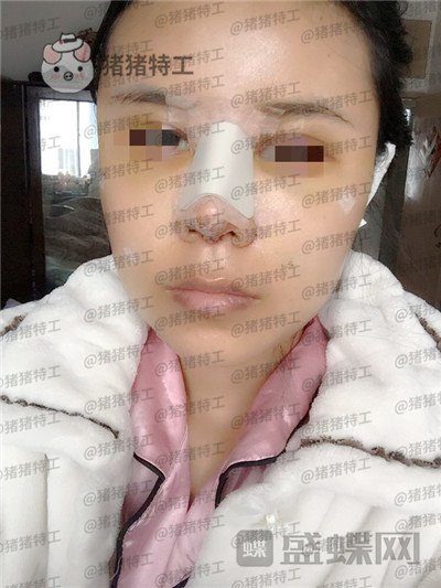 上海愉悦美联臣陈红梅脂肪填充案例价格分享,大家来帮我看看这是整形失败了吗?