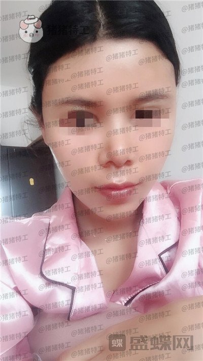 上海愉悦美联臣陈红梅脂肪填充案例价格分享,大家来帮我看看这是整形失败了吗?