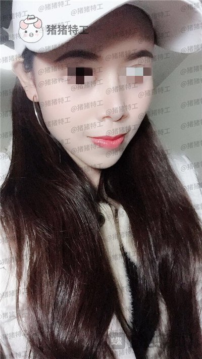 上海愉悦美联臣陈红梅脂肪填充案例价格分享,大家来帮我看看这是整形失败了吗?
