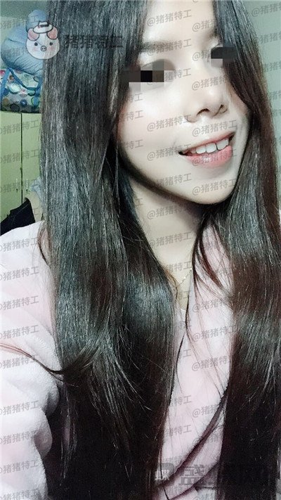 上海愉悦美联臣陈红梅脂肪填充案例价格分享,大家来帮我看看这是整形失败了吗?
