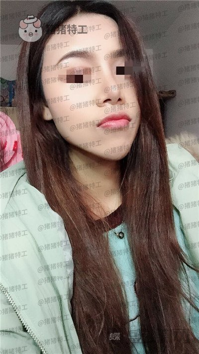上海愉悦美联臣陈红梅脂肪填充案例价格分享,大家来帮我看看这是整形失败了吗?