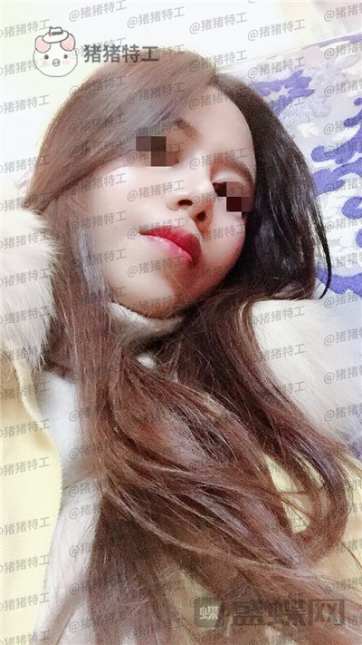 上海愉悦美联臣陈红梅脂肪填充案例价格分享,大家来帮我看看这是整形失败了吗?