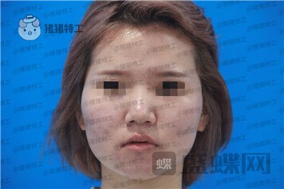西安医学院陈杰鼻部手术案例价格分享,脸上这么多痘痘被好看的鼻子拯救了。