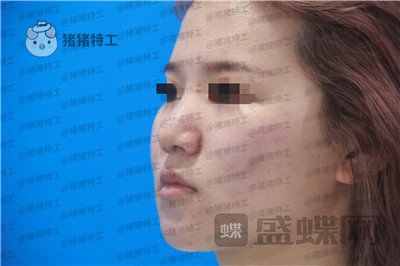 西安医学院陈杰鼻部手术案例价格分享,脸上这么多痘痘被好看的鼻子拯救了。