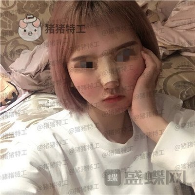 西安医学院陈杰鼻部手术案例价格分享,脸上这么多痘痘被好看的鼻子拯救了。