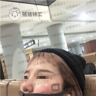 西安医学院陈杰鼻部手术案例价格分享,脸上这么多痘痘被好看的鼻子拯救了。