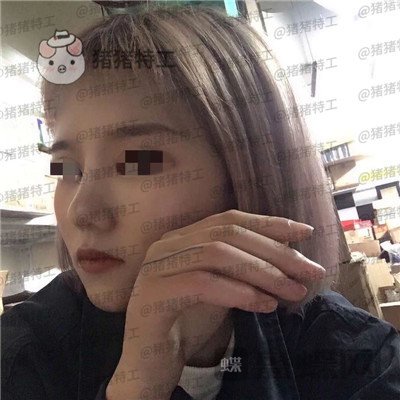 西安医学院陈杰鼻部手术案例价格分享,脸上这么多痘痘被好看的鼻子拯救了。