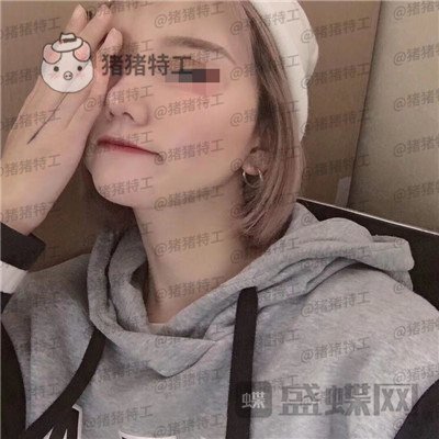 西安医学院陈杰鼻部手术案例价格分享,脸上这么多痘痘被好看的鼻子拯救了。