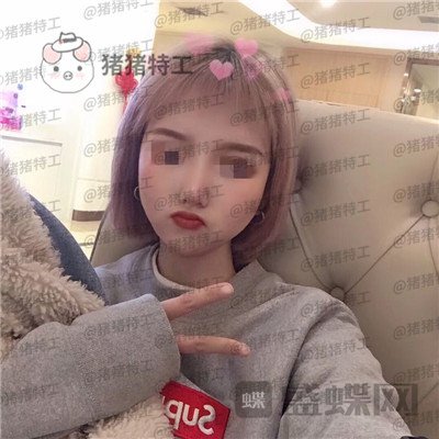 西安医学院陈杰鼻部手术案例价格分享,脸上这么多痘痘被好看的鼻子拯救了。