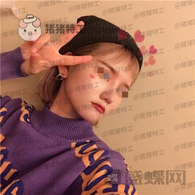 西安医学院陈杰鼻部手术案例价格分享,脸上这么多痘痘被好看的鼻子拯救了。