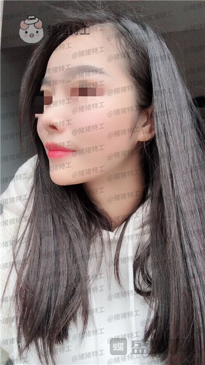 重庆铂生杜亚旭鼻部手术案例价格分享,做出来的鼻子到底自然吗?