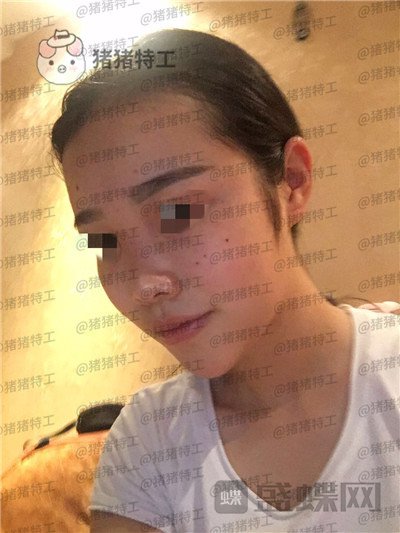 重庆铂生杜亚旭鼻部手术案例价格分享,做出来的鼻子到底自然吗?
