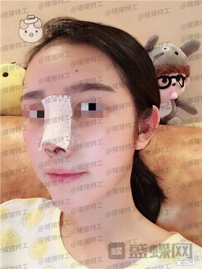 重庆铂生杜亚旭鼻部手术案例价格分享,做出来的鼻子到底自然吗?