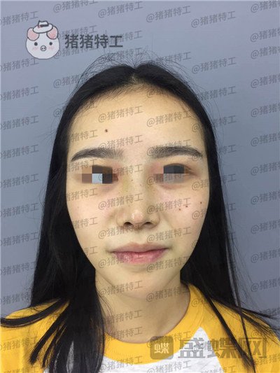 重庆铂生杜亚旭鼻部手术案例价格分享,做出来的鼻子到底自然吗?