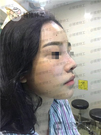 重庆铂生杜亚旭鼻部手术案例价格分享,做出来的鼻子到底自然吗?