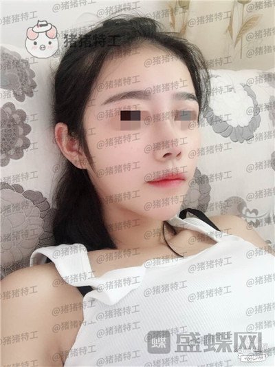 重庆铂生杜亚旭鼻部手术案例价格分享,做出来的鼻子到底自然吗?