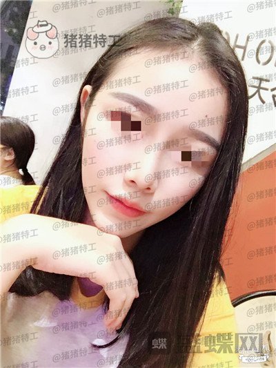 重庆铂生杜亚旭鼻部手术案例价格分享,做出来的鼻子到底自然吗?