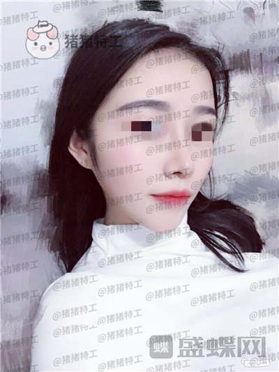 重庆铂生杜亚旭鼻部手术案例价格分享,做出来的鼻子到底自然吗?