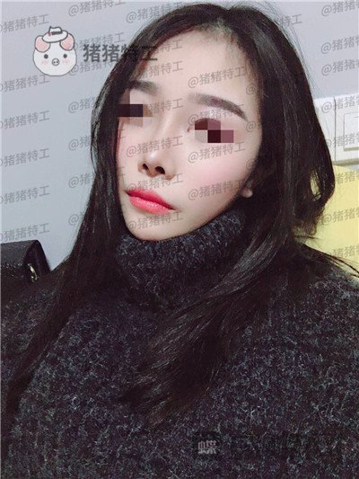 重庆铂生杜亚旭鼻部手术案例价格分享,做出来的鼻子到底自然吗?