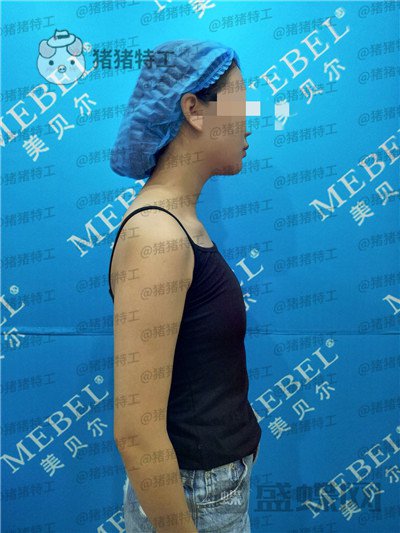南京美贝尔黄名斗隆胸案例价格分享,感觉自己都备注自己诱惑到了~~