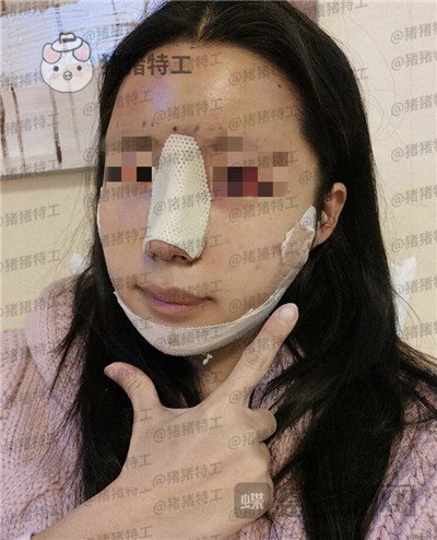 上海九院张盈帆隆鼻案例价格分享,仙女的鼻子是怎么养成的?