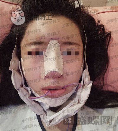 上海九院张盈帆隆鼻案例价格分享,仙女的鼻子是怎么养成的?