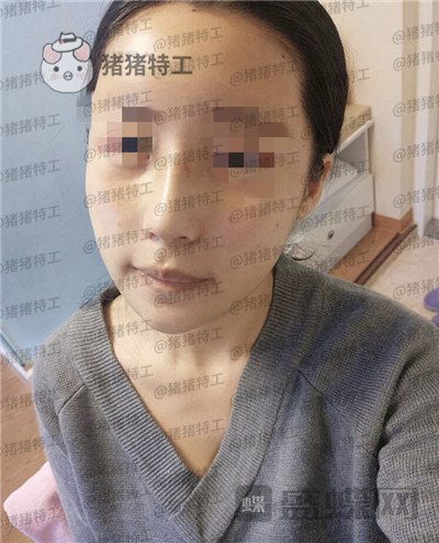 上海九院张盈帆隆鼻案例价格分享,仙女的鼻子是怎么养成的?