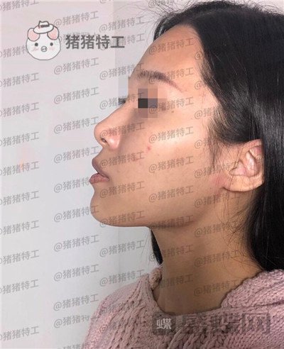 上海九院张盈帆隆鼻案例价格分享,仙女的鼻子是怎么养成的?