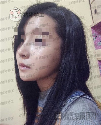 上海九院张盈帆隆鼻案例价格分享,仙女的鼻子是怎么养成的?