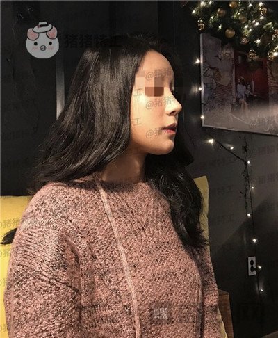 上海九院张盈帆隆鼻案例价格分享,仙女的鼻子是怎么养成的?