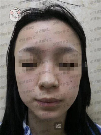 成都西区医院车红昌隆鼻案例价格分享,亲戚都说我鼻子高高的很好看~